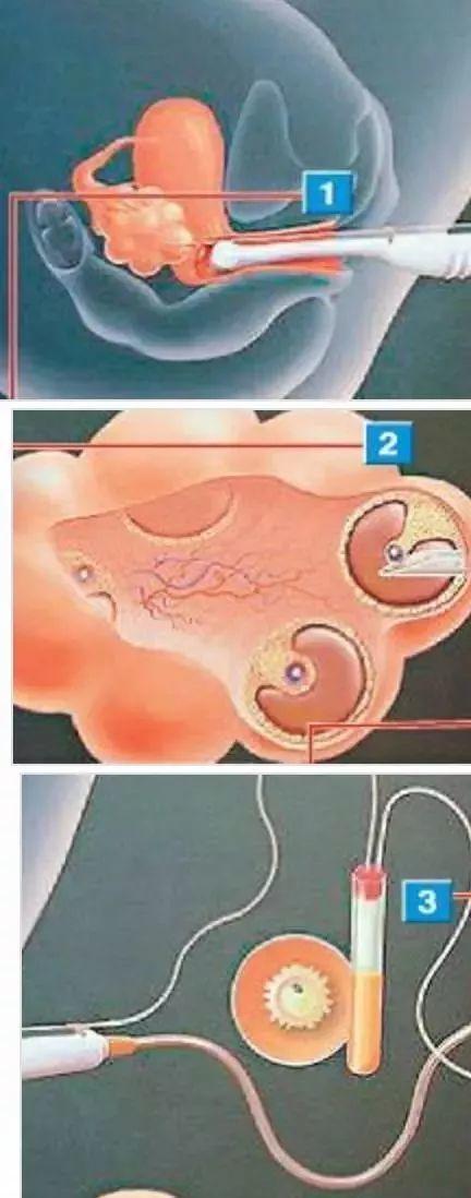 试管借卵生孩子_试管借卵生孩子：现代生育方式的探讨